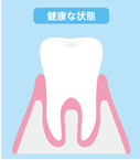 青森県 青森市緑 ミドリデンタルクリニック　歯茎はピンク色で引き締まっています。歯周溝（歯周ポケット）は1〜2mm程度です。