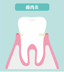 青森県 青森市緑 ミドリデンタルクリニック　歯垢（プラーク）が溜まり、歯茎に赤み・腫れなどの炎症が起こります。歯周溝が徐々に広がってきます。