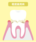 青森県 青森市緑 ミドリデンタルクリニック　歯石を放置すると、歯石となります。歯茎の炎症が拡大し、歯磨きで出血することもあります。