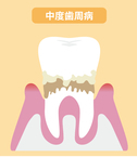 青森県 青森市緑 ミドリデンタルクリニック　歯を支える歯槽骨が溶け始めます。歯茎の炎症はさらに悪化し、膿が溜まり、口臭もきつくなります。