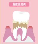 青森県 青森市緑 ミドリデンタルクリニック　歯肉溝は6mm以上になります。歯槽骨は半分以上溶け出し、支えを失って、歯がぐらぐらするようになります。