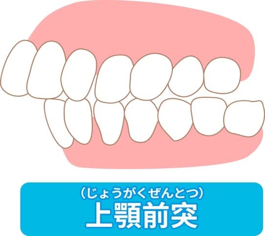 上顎前突