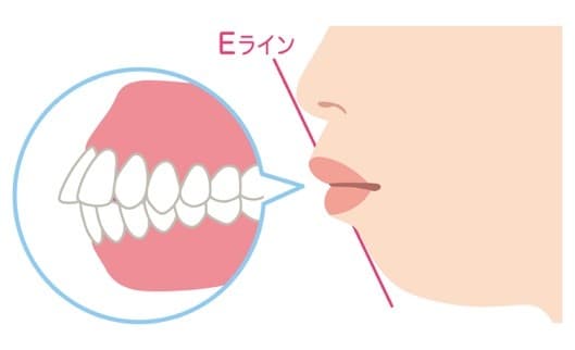 上顎前突②