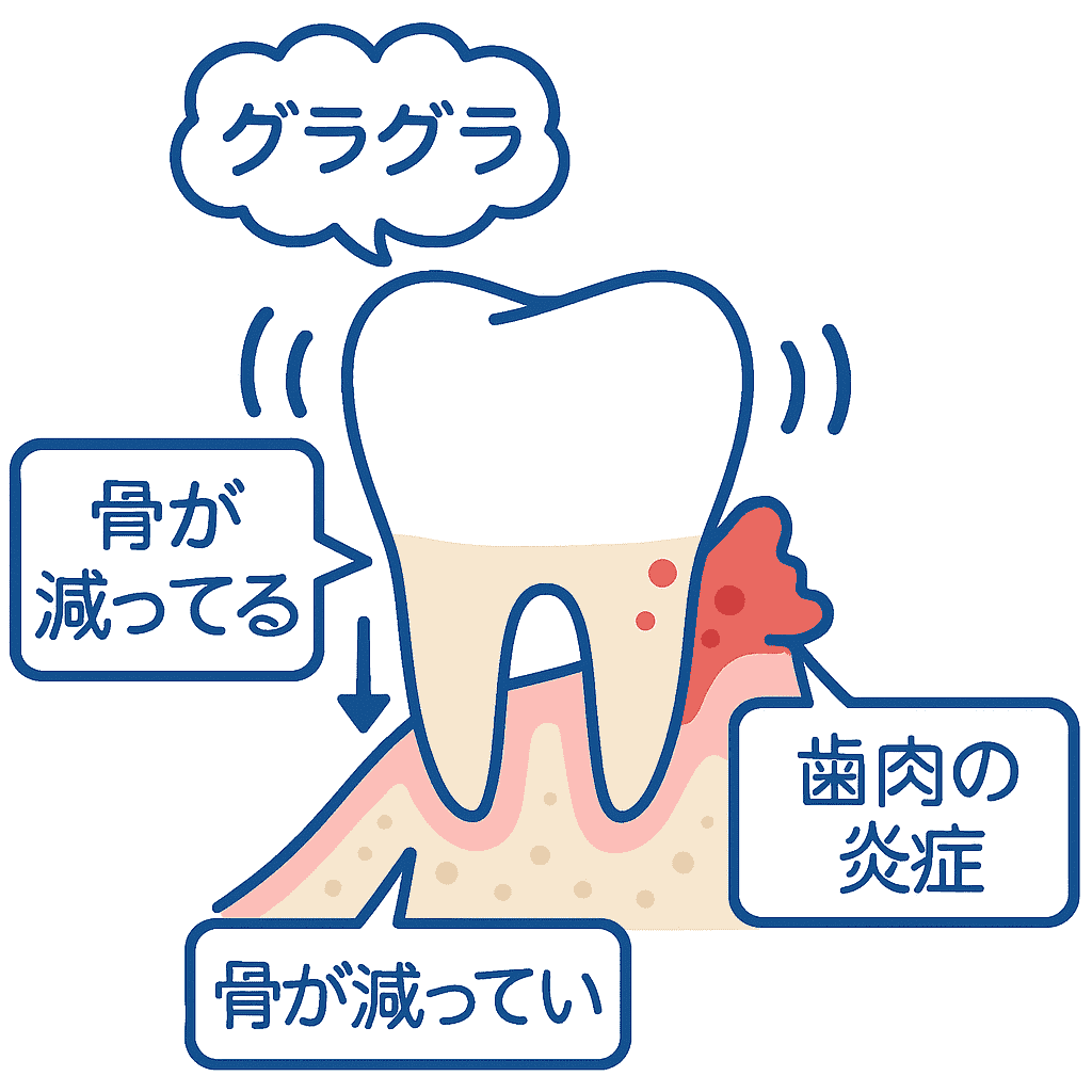 歯のぐらつき