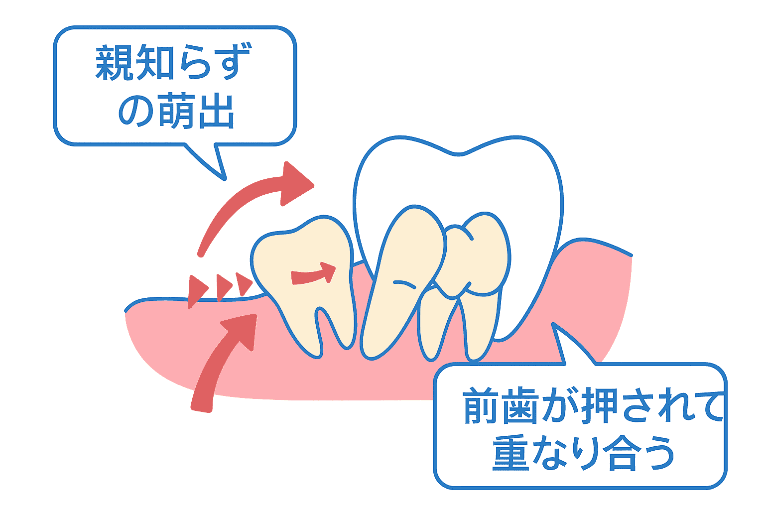 親知らず